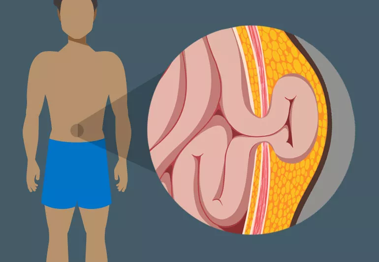 Why Can’t a Hernia Heal Naturally?