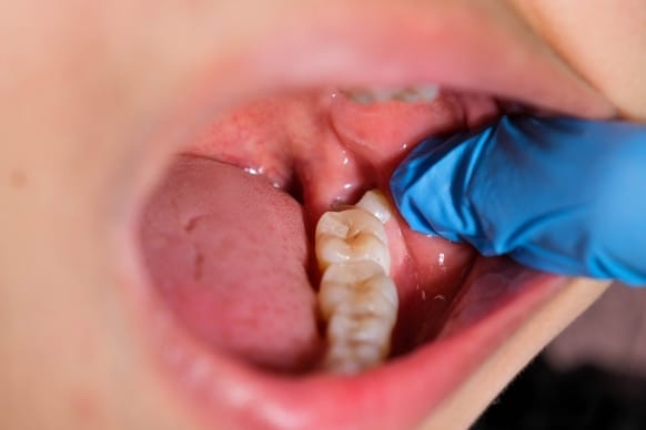 What Is the Typical Healing Timeline for Wisdom Teeth: