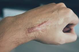 How Long Does It Take for a Scar to Heal Based on Different Scar Types?