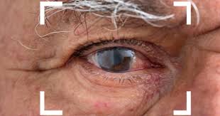 What Is Cataract Surgery: