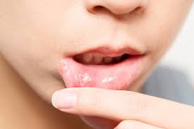 What Are Oral Ulcers from Chemotherapy: