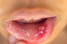 Tips for Faster Healing of Oral Ulcers: