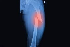 Treatment Options for a Broken Femur: