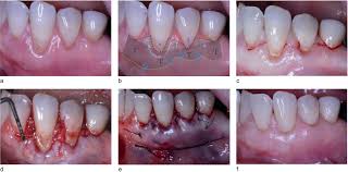 Graft Displacement or Movement: