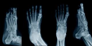 Understanding Stress Fractures