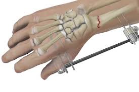 Factors Influencing Hand Fracture Recovery: