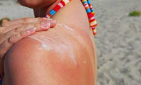 Effective Home Remedies for Sun Poisoning: