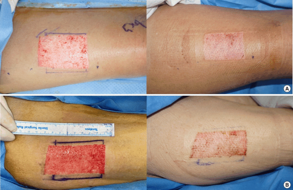 Skin Graft Healing Stages: A Complete Guide with Pictures