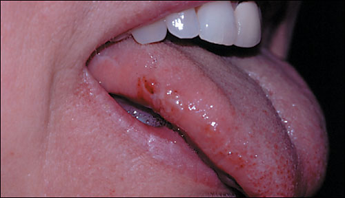 Why Tongue Bites Occur: