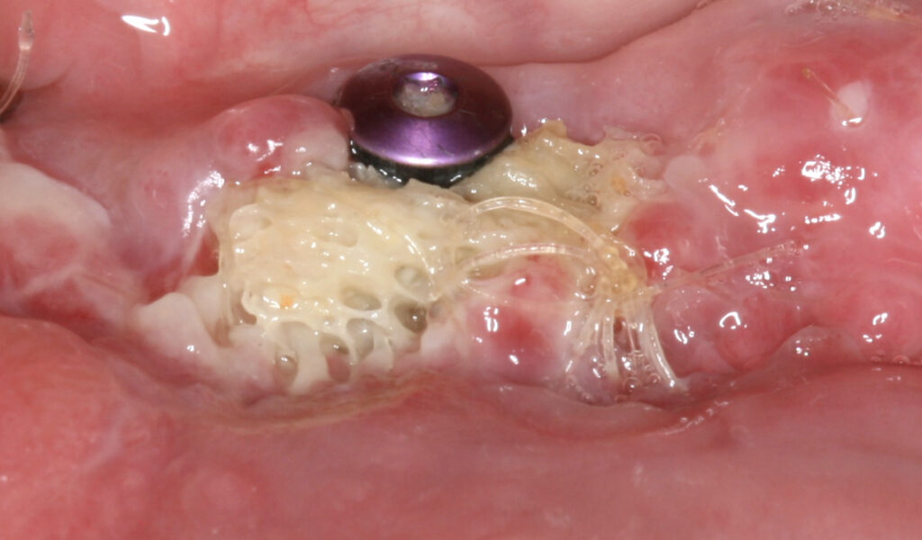 Imaging and Diagnosis of Failed Bone Grafts: