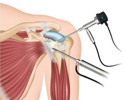 Phases of Healing for a Dislocated Shoulder: