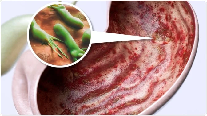 Understanding Stomach Ulcers and H. Pylori Infection: