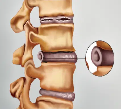 What Is a Bulging Disc?