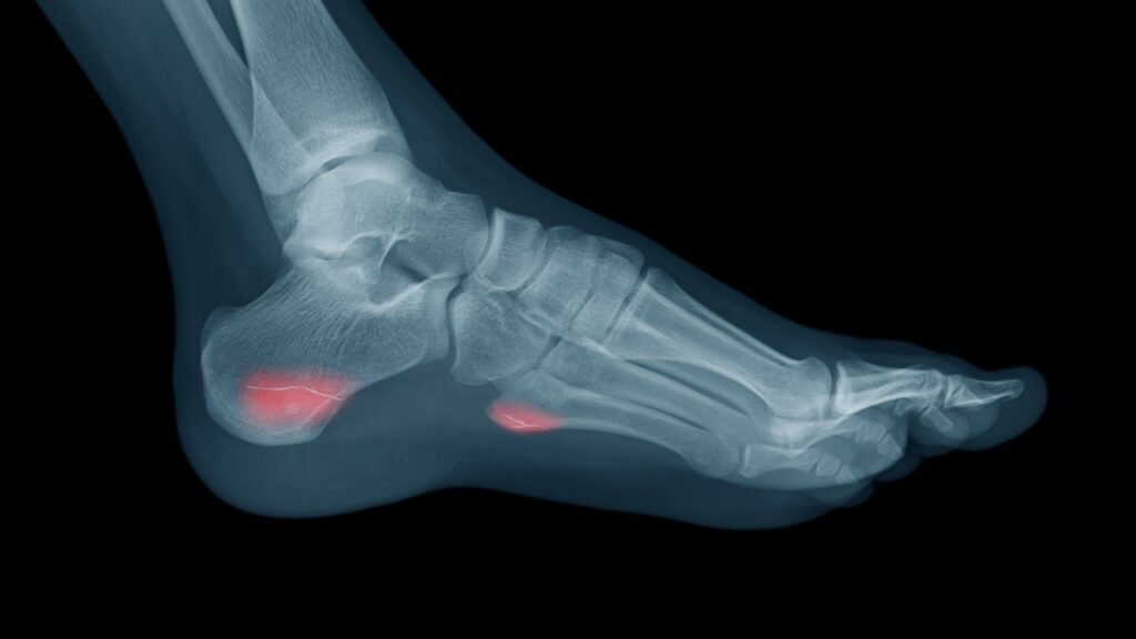 What is a Stress Fracture: