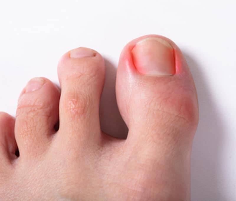 Toenail Removal Healing Stages: What to Expect with Pictures?