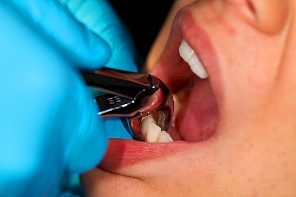 Why Are Teeth Extracted?