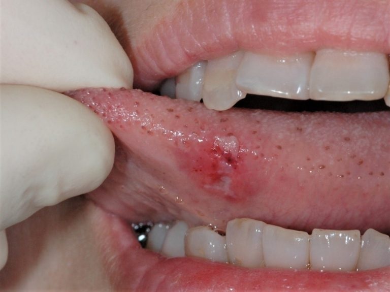 Timeframe for Healing a Bitten Tongue: