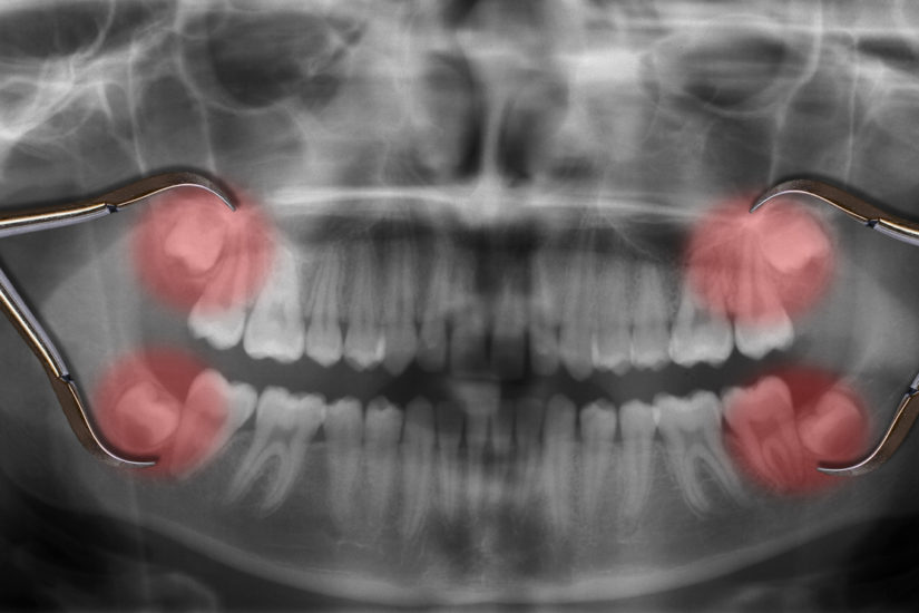 Full Recovery Timeline: Week-by-Week