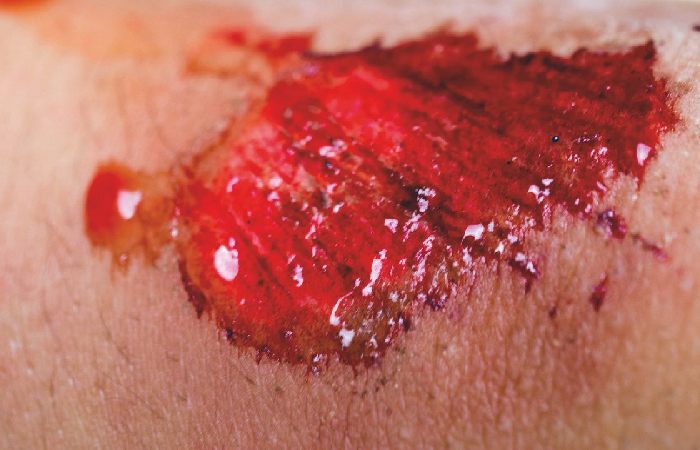 Understanding the Wound Healing Process: