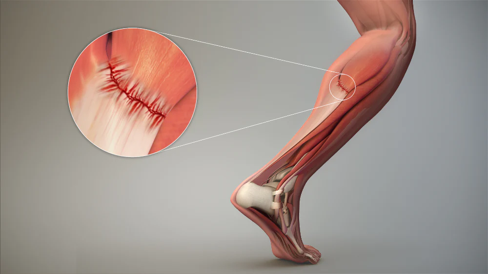 Understanding a Torn Muscle: