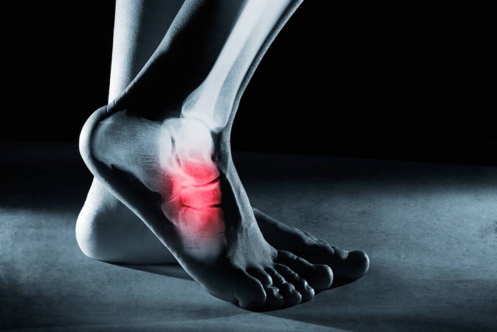 Understanding Broken Foot Injuries: