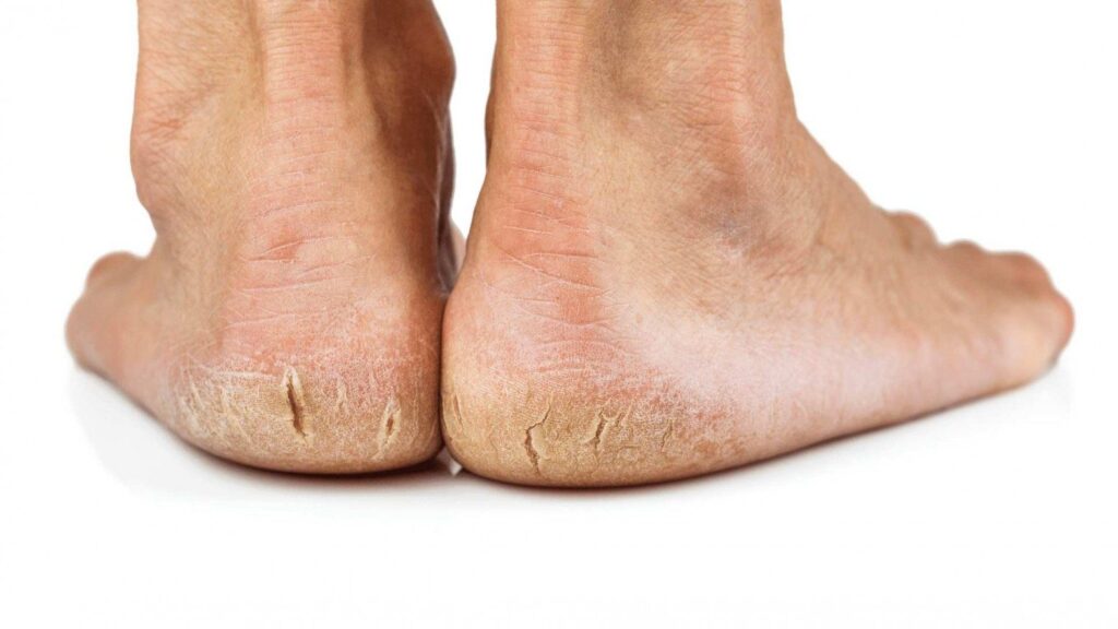 Causes of Cracked Feet: