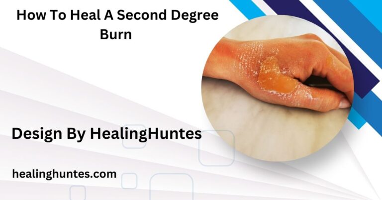 How To Heal A Second Degree Burn - Tips for Quick Recovery!