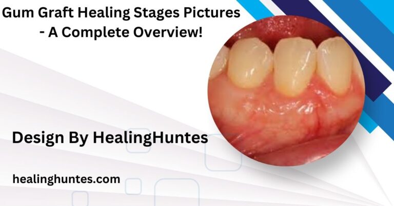 Gum Graft Healing Stages Pictures - A Complete Overview!