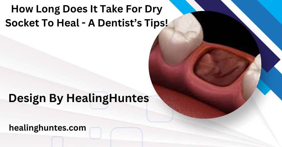 How Long Does It Take For Dry Socket To Heal - A Dentist’s Tips!