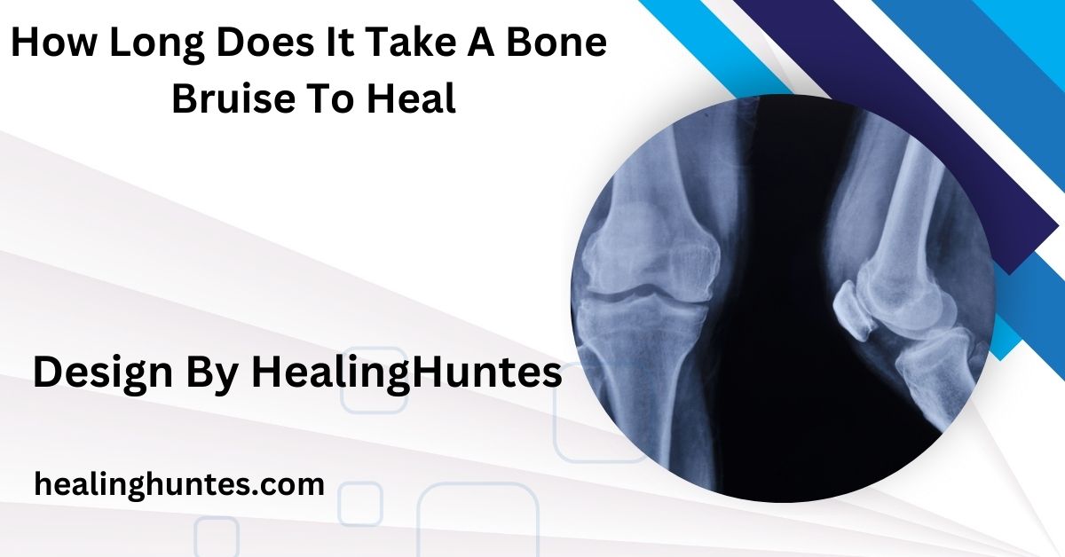 How Long Does It Take A Bone Bruise To Heal