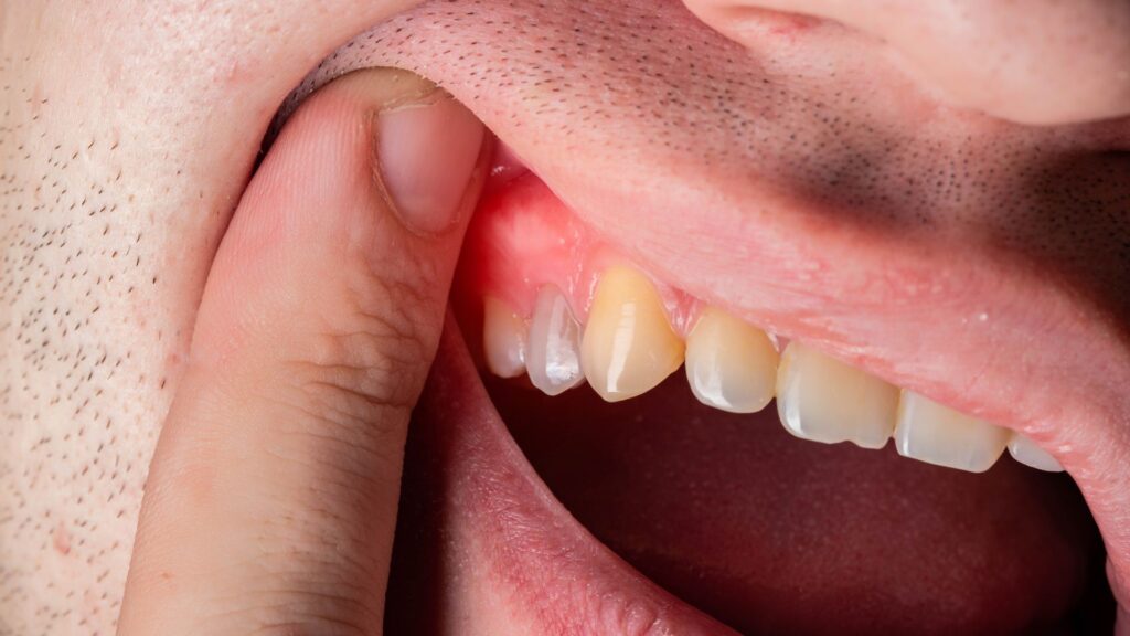 Understanding Swollen Gums: