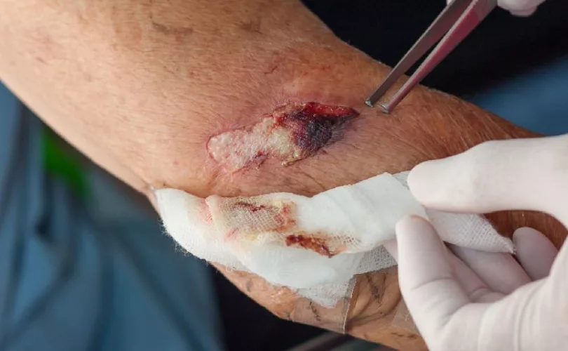 Is Yellow Tissue in a Wound Dangerous: