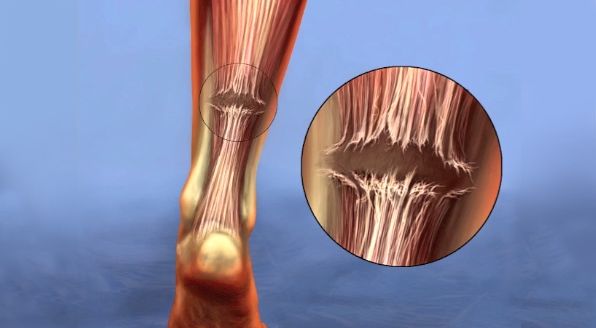 Understanding an Achilles Tendon Tear: