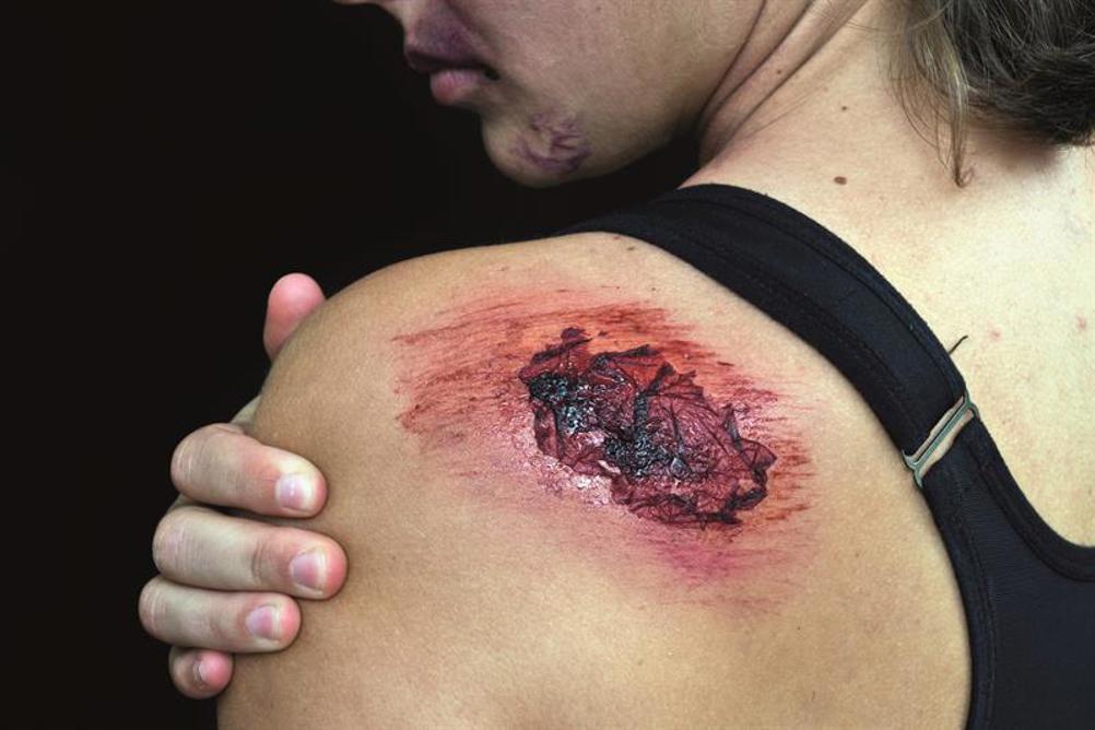 Understanding the Wound Healing Process: