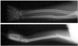 Understanding the Basics of Arm Fractures: