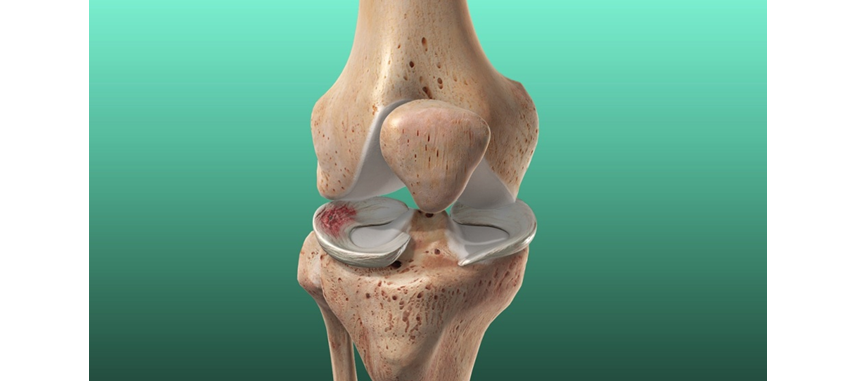 Understanding a Torn Meniscus: