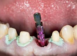 Abutment Placement: (3-6 Months)