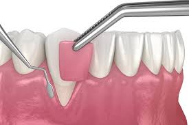 Gum Graft Healing Stages: