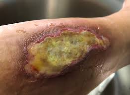 What is Yellow Tissue in a Wound: