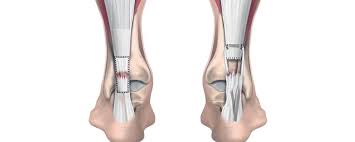 Surgical Treatment for a Torn Achilles Tendon: