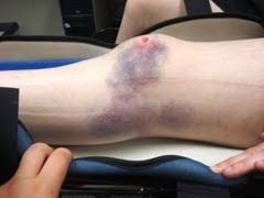 What Is a Bone Bruise?