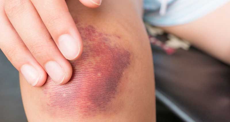 What is a Bone Bruise: