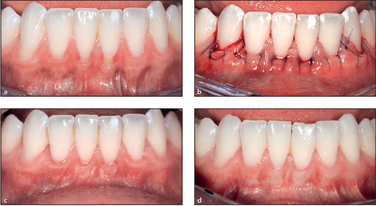 Gum Graft Healing Stages: